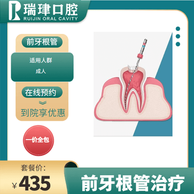 天津根管治疗-前牙根管治疗1颗活动图片