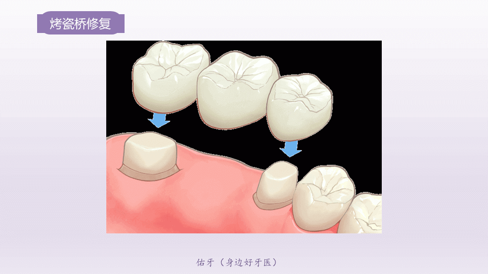 烤瓷桥修复
