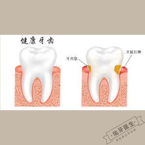 牙周袋怎么治疗？
