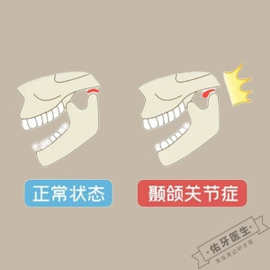颞下颌关节紊乱怎么治疗？