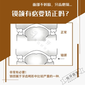锁颌有必要矫正吗？