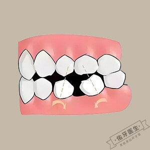 牙齿移位怎么办？