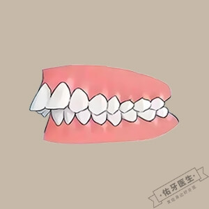  龅牙怎么矫正？