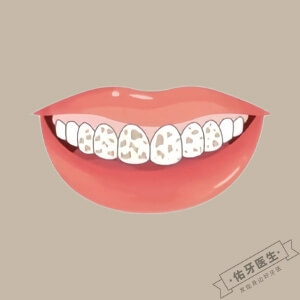 氟牙症怎么治疗？