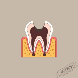 根尖周炎怎么治疗？