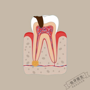 急性根尖周炎怎么治疗