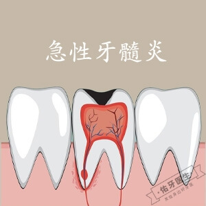 急性牙髓炎最有效的治疗方法