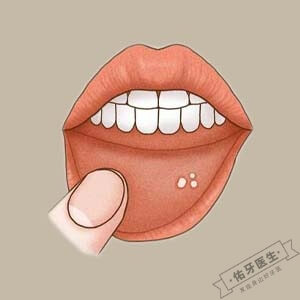 口腔溃疡怎么办？