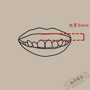 露龈笑怎么矫正?