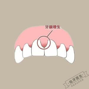 牙龈增生logo图