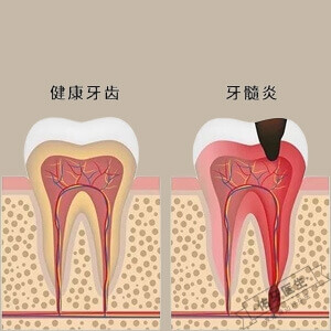 急性牙髓炎logo图