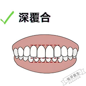 深覆合矫正方法