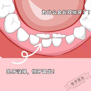 孩子长出双排牙怎么办？