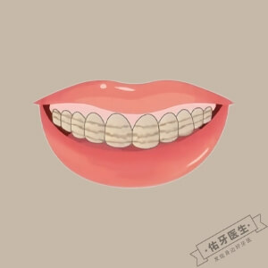 四环素牙怎么办？