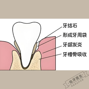 牙槽骨吸收怎么办？