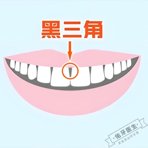 黑三角牙齿可以恢复吗？