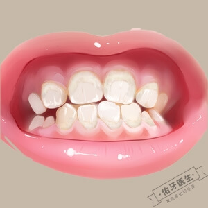 牙齿脱矿怎么办？