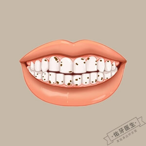 牙菌斑怎么去除?