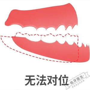 牙齿咬合不正怎么办？