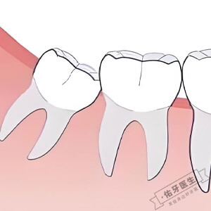 智齿一定要拔掉吗？
