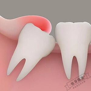 智齿冠周炎怎么治疗？