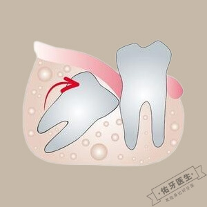 智齿阻生怎么办？