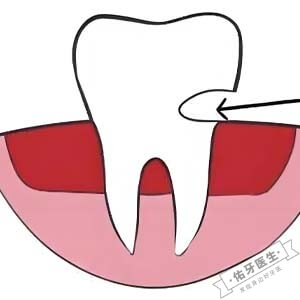 牙齿楔状缺损怎么办？