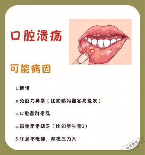 口腔溃疡怎么办？快速止痛和加速愈合的有效方法 - 佑牙医生