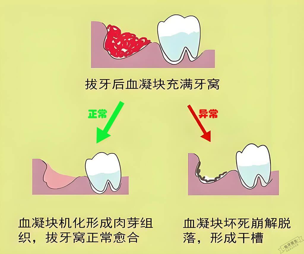 拔牙后干槽症与正常情况对比图