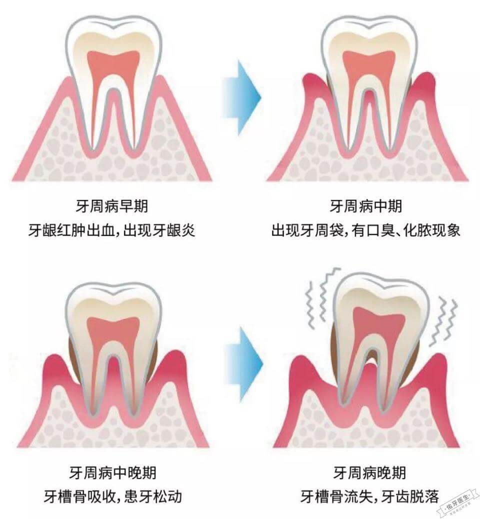 牙周病症状与治疗:从早期征兆到有效治疗方法 - 佑牙医生