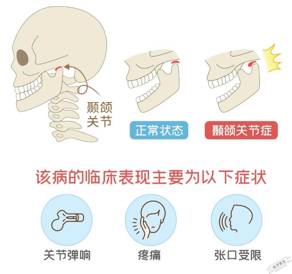 颞下颌关节紊乱怎么治疗?一篇读懂所有方法 - 佑牙医生