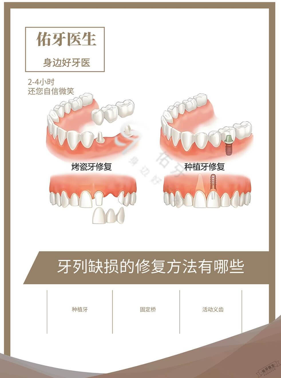 牙列缺损的修复方法有哪些? - 佑牙医生