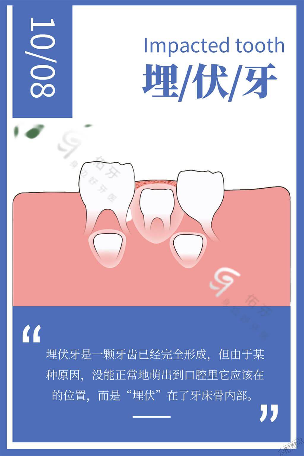 埋伏牙是什么意思?30秒了解埋伏牙的症状、危害与治疗 - 佑牙医生