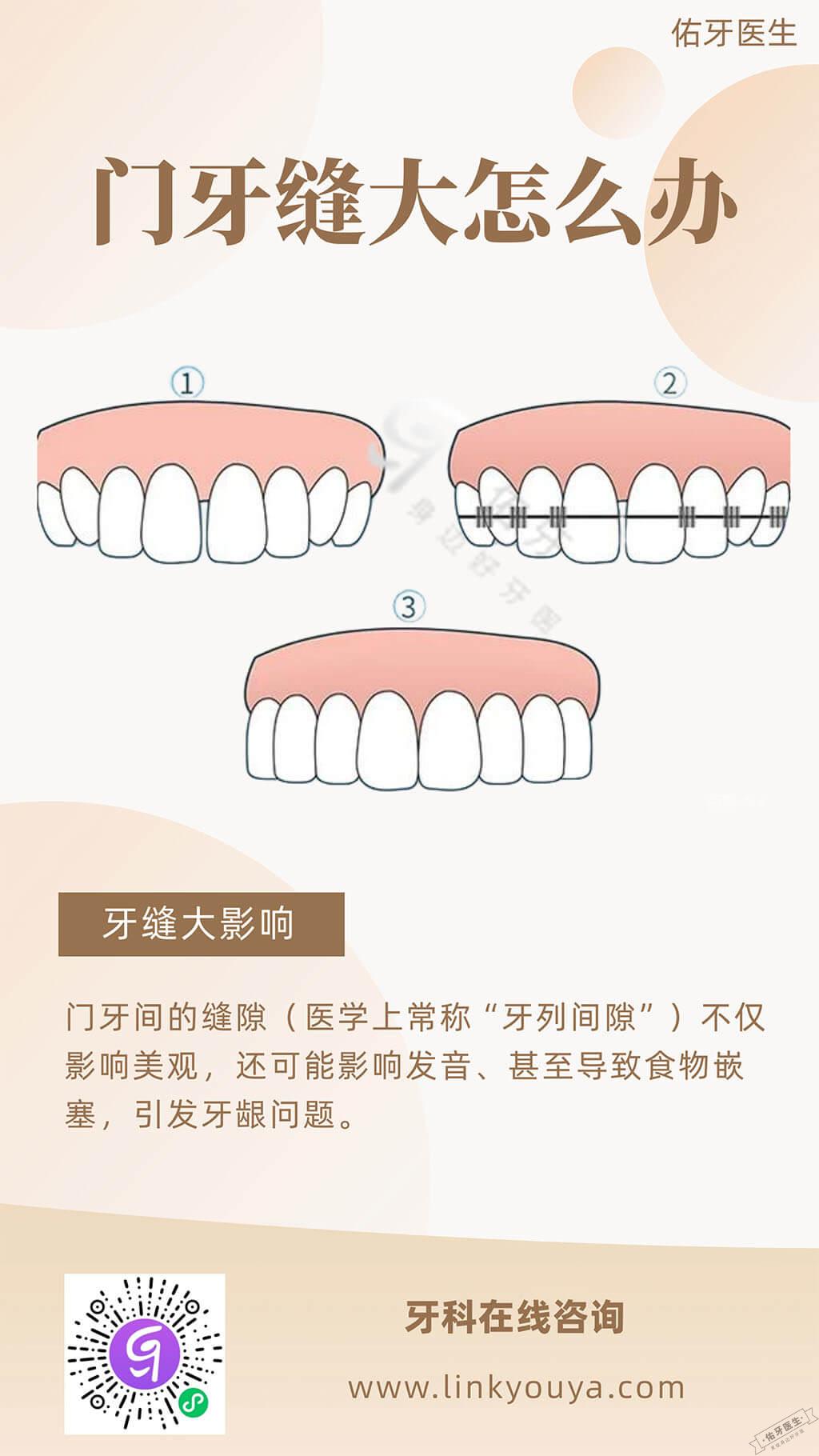 中间两颗门牙缝大怎么办? - 佑牙医生