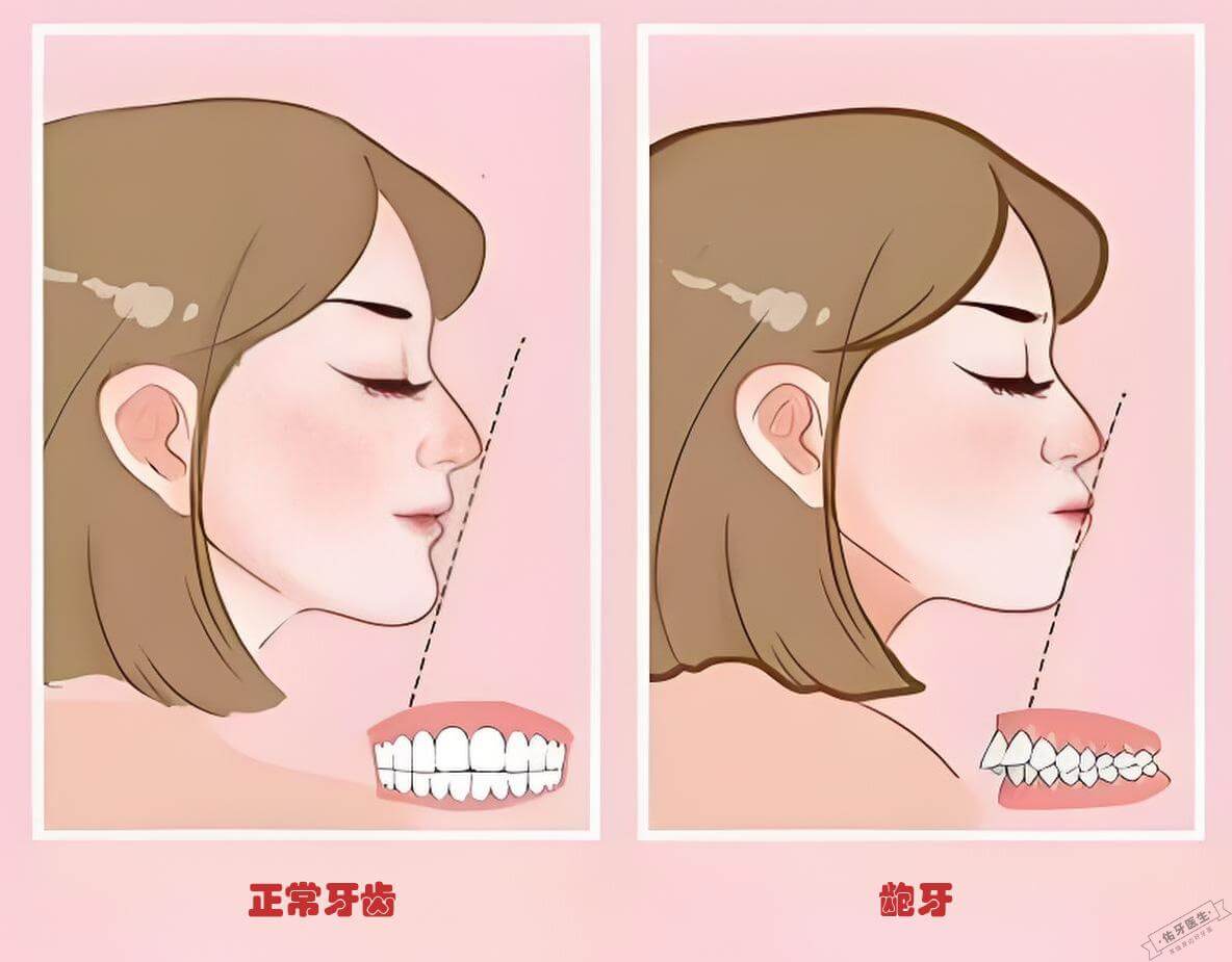 龅牙与正常牙齿对比图