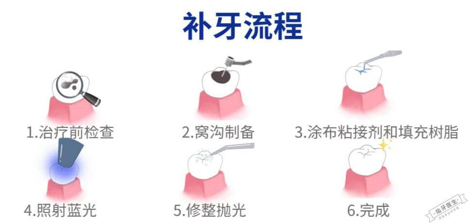 补牙齿过程全解析:从检查到术后护理的详细指南 - 佑牙医生