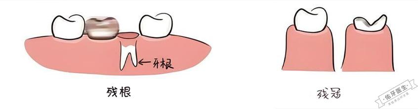 牙齿残根残冠图