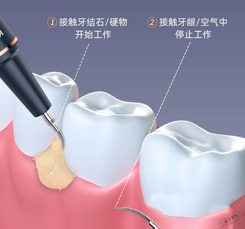 超声波洁牙原理