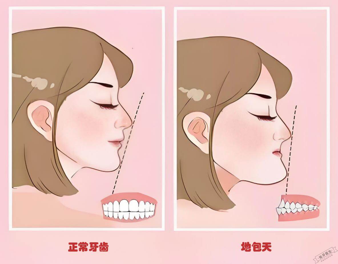 地包天与正常牙齿对比图