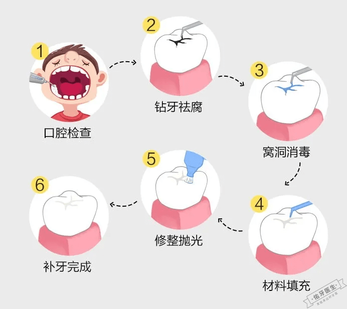 补牙过程图