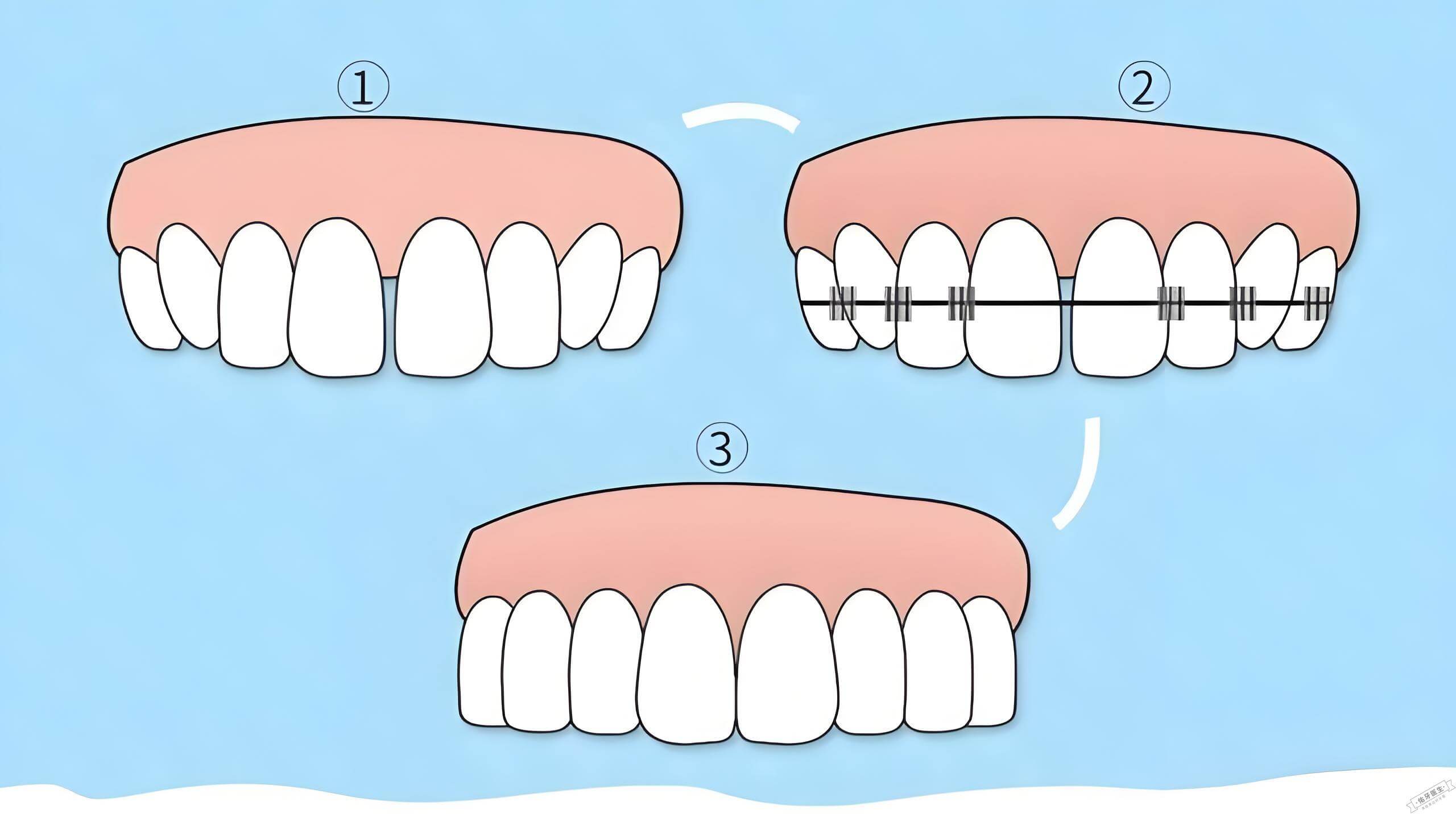 牙缝大矫正过程示意图