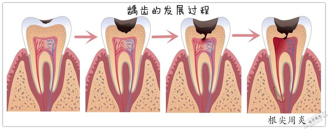 龋齿发展为根尖周炎