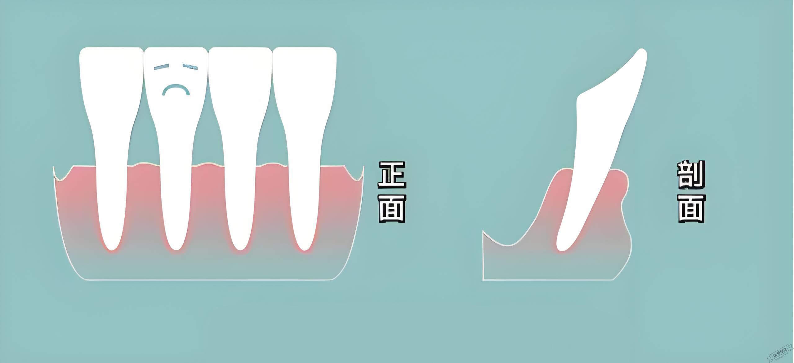 中度牙根吸收正侧面图