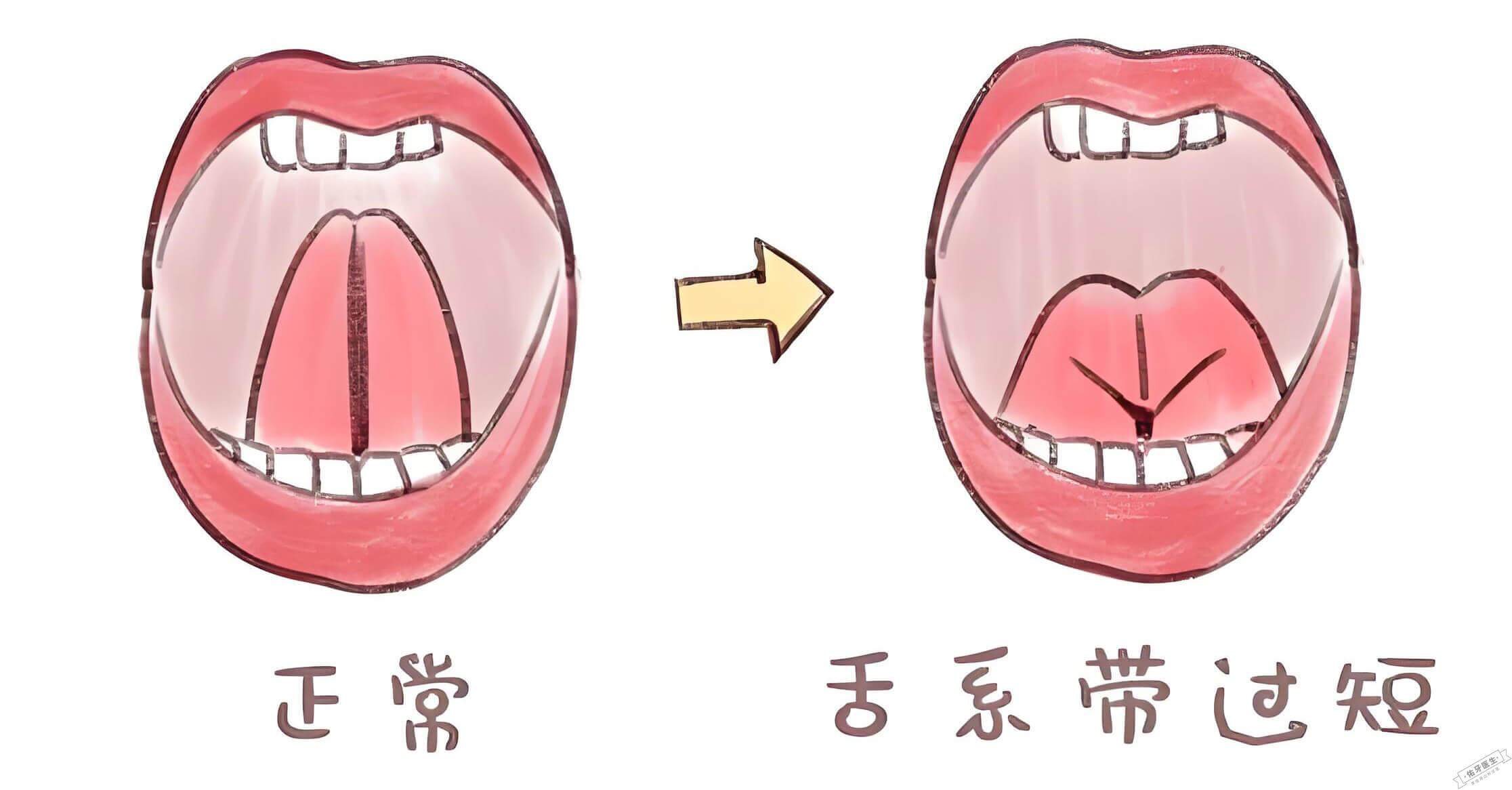 舌系带正常与过短对比图