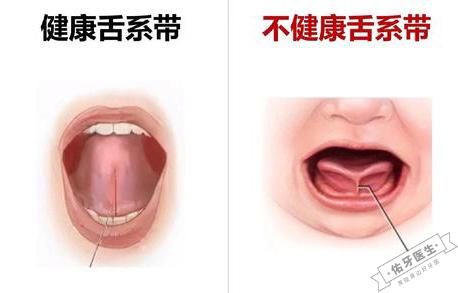 舌系带短与正常舌系带对比图
