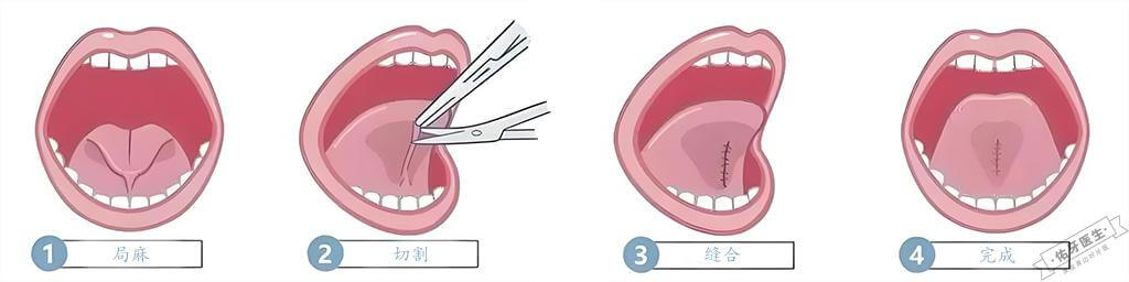 舌系带矫正过程