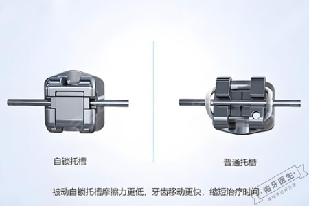 自锁牙套和普通托槽的区别