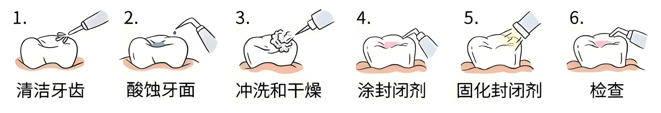 窝沟封闭的步骤