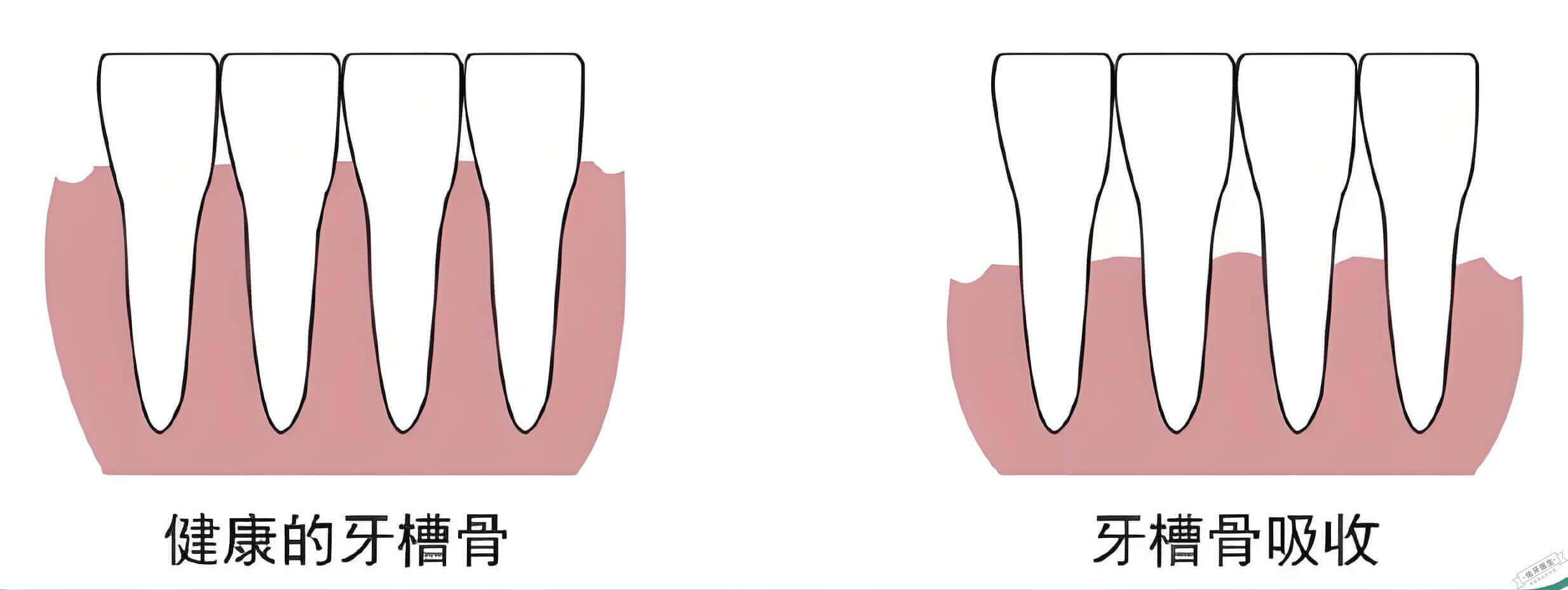 牙槽骨吸收对比图