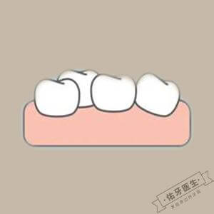 牙齿不齐2